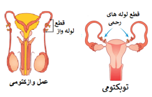 عمل وازکتومی
